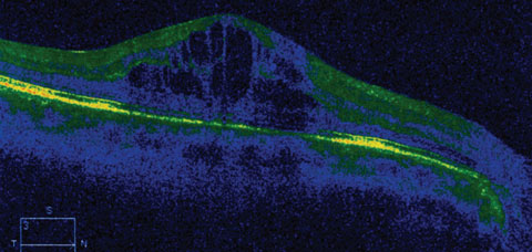 This OCT image shows an eye with CME following travoprost treatment.