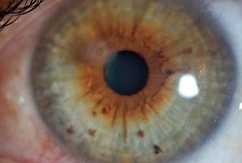 This patient was referred in for evaluation of scar caused by a foreign body and rust ring removal.