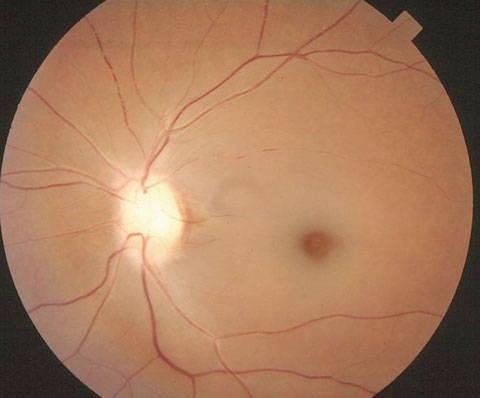 Narrowed, attenuated retinal arterioles in retinal artery occlusion.