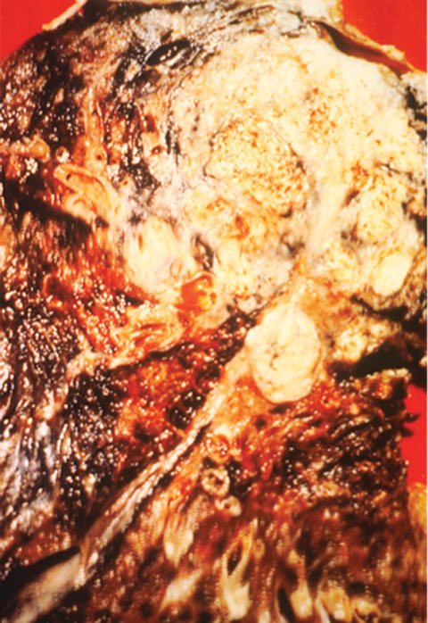 Cross-section of a lung. The black areas indicate the patient was a smoker, and the white area is cancer.