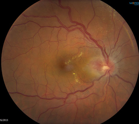 Fig. 1. This fundus photo shows the optic nerve and macula of the 38-year-old patient’s right eye.
