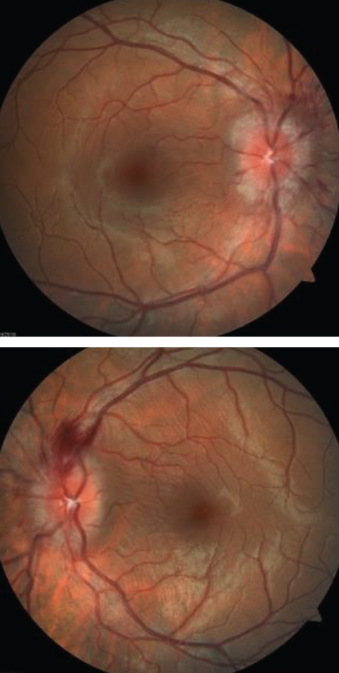 The optic disc edema seen in these fundus images is a telltale sign of the neuro-ophthlamic condition papilledema.