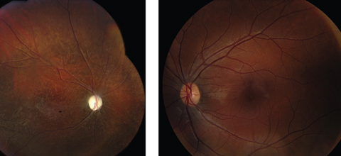 Fig. 1. Fundus photo of the right eye (at left) during the late stage with optic atrophy, retinal arterial narrowing and degenerative changes in the retina. The left eye appears normal. 
