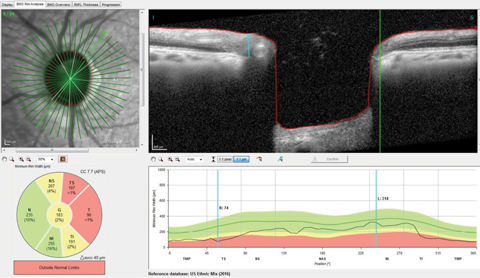 Fig. 2. You can see the thinned superotemporal Bruch’s membrane opening radial scan with minimal rim tissue thickness in this scan at 74µm, well outside the reference database for normals.