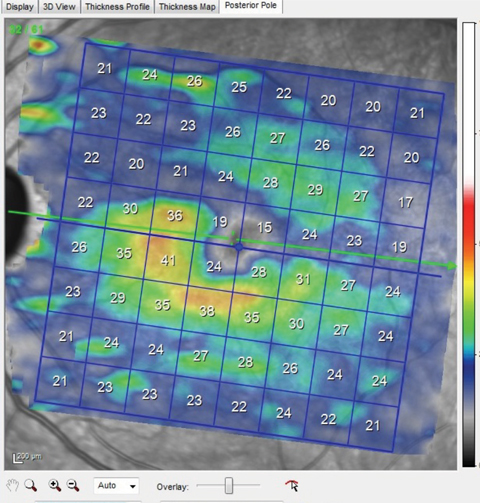 Fig. 3. Note the thinned ganglion cell layer above the horizontal meridian that matches perfectly with the wedge defect seen in the multicolor image shown earlier. This macular ganglion cell layer thinning also matches up to the thinned superotemporal BMO scan also shown earlier.