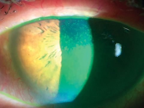 Corneal staining shows advanced loss of epithelial barrier in severe dry eye with loss of the mucoadhesive layer and poor wettability of the tear film.