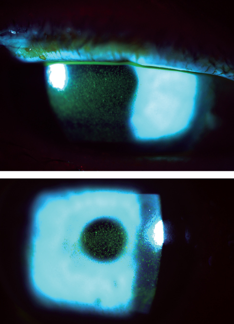 This patient’s punctate epithelial keratopathy involves the central cornea in a case of Sjögren’s-related dry eye.