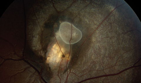 Fig. 1. Fundus photo of the right eye showing the area of interest. What does this represent?