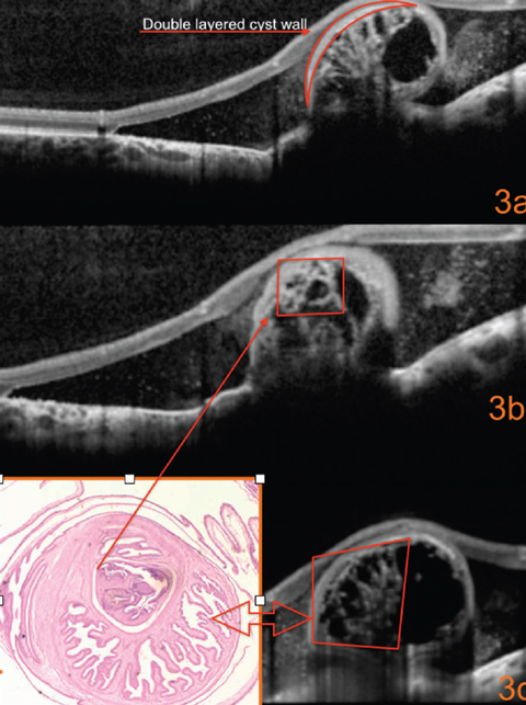 Fig. 3. What can this detailed look at the SD-OCT image reveal?