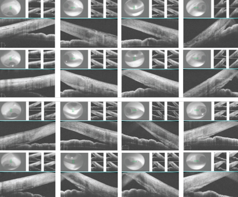 These images show each quadrant of the patient’s eyes, both pre- and postoperatively. The first row shows the right eye preoperatively, the second row shows the right eye postoperatively, the third row shows the left eye preoperatively and the last row shows the left eye postoperatively. 