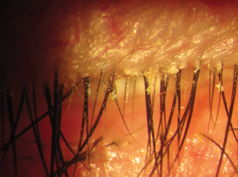 Fig. 3. Multiple cylindrical dandruff and telangiectsia of lid margin and base of lashes may lead to a diagnosis of MGD/Demodex/posterior blepharitis.