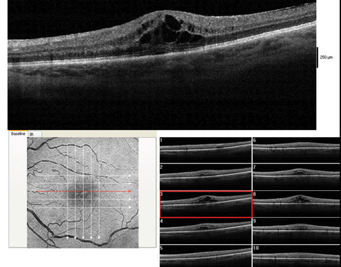 These images show a moderate macular edema, diagnosed four weeks after surgery. With 1% prednisolone acetate QID and flurbiprofen QID, this patient recovered to 20/25 over the course of two months.