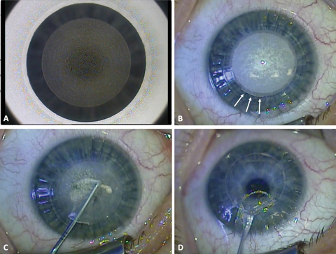 Fig. 1. These images depict the SMILE surgical procedure from start to finish. A) During the laser procedure, the posterior lenticule surface has been cut. B) After the anterior lenticule surface has been cut, a 40-degree incision is created (arrows). C) Next is careful dissection of the lenticule with a blunt Chansue dissector. The superior surface of the lenticule is dissected followed by the posterior surface. D) Finally, the lenticule is extracted through the small periphal incision.