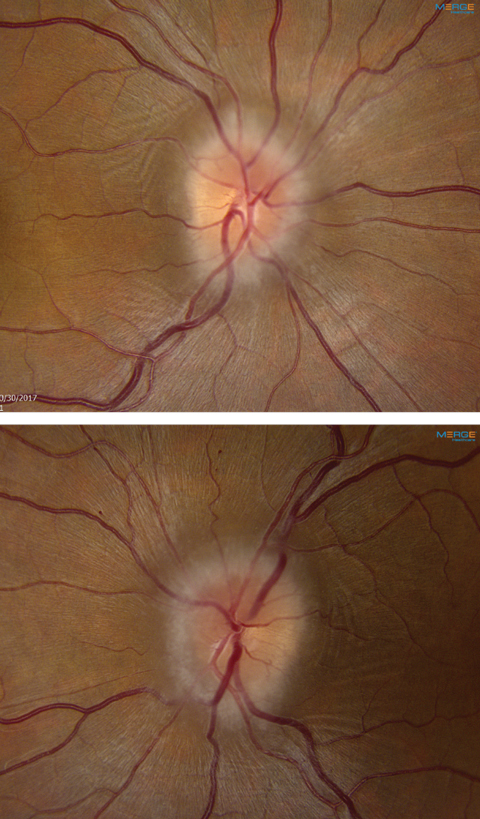 Fig. 1. These fundus images show the right (at top) and left optic nerves of our 34-year-old patient. What can they tell you about her likely diagnosis?