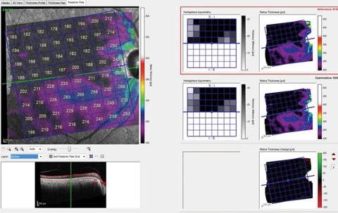 Fig. 2. These images show the patient’s total macular retinal thickness over two separate visits, with essentially no discernible change over the (short) time frame between scans.