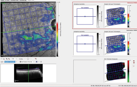 Fig. 2. These images show the patient’s total macular retinal thickness over two separate visits, with essentially no discernible change over the (short) time frame between scans.