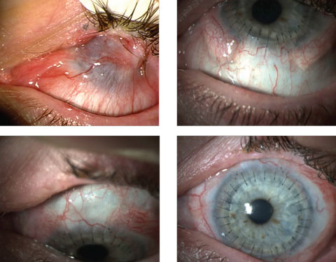 These images show a patient with epithelial defects before (top left) and after stem cell therapy in conjunction with corneal transplantation.