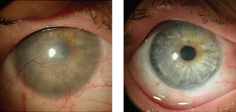 At left, this patient’s LSCD was due to Stevens-Johnson syndrome. At right, a CLAL procedure (from her fellow eye) resulted in a healed, smooth corneal surface with no immunosuppression. 