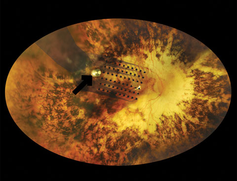 This fundus photograph shows the electrode array component of the Argus II, which has been fastened to the recipient’s retina via the metallic tack (black arrow).