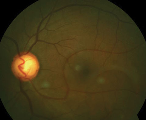 Here is an inferior congenital retinal macrovessel extending over the horizontal raphe.