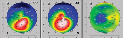 Fig. 5. An example of topographic flattening seen as early as three months after standard (epi-off) corneal crosslinking protocol. The left map shows the patient’s pre-operative axial topography. The center map is the postoperative topography at month three, and the right map provides a difference calculation revealing the topographic improvement at month three.