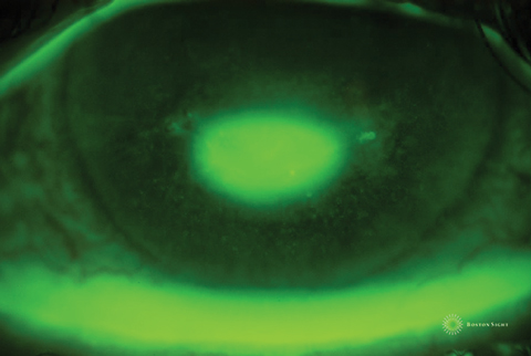 Fig. 2. Picture of an epithelial defect taken several minutes after fluorescein instillation. As the fluorescein absorbs into the stroma, the edges are obscured, making it difficult to determine its exact size and shape.