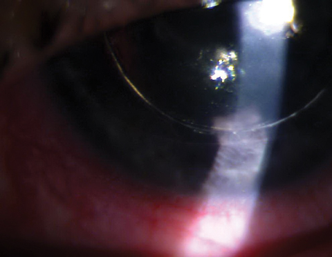 DSEK with gas/air bubble posterior to the iris causing pupillary block. 