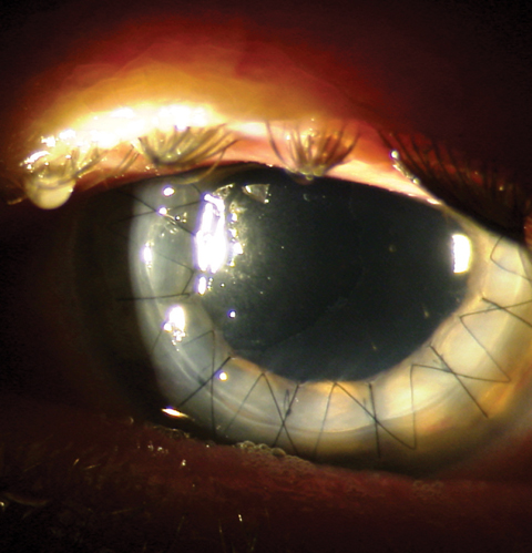 This postoperative patient demonstrates full-thickness penetrating keratoplasty graft with a running suture in place.