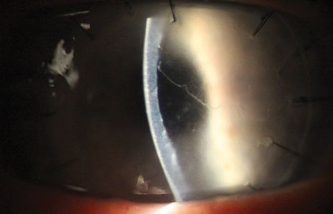 Khodadoust line and corneal graft rejection as seen in a PKP patient.