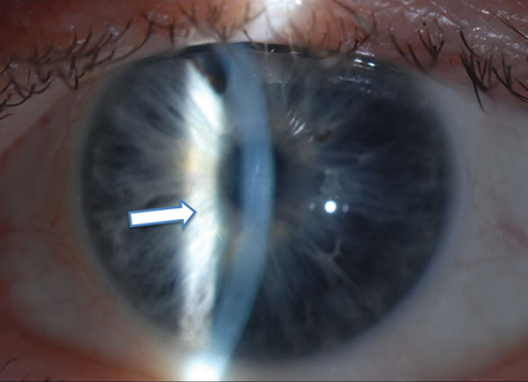 One month postoperative appearance following 4mm Descemet’s stripping without endothelial keratoplasty in a 64-year-old man with Fuchs’ dystrophy. The arrow highlights the edge of the descemetorhexis.