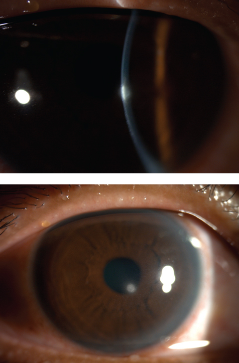 Figs. 4 and 5. Central corneal infiltrates from contact lens wear.
