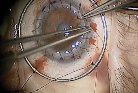 Traditional PK, as seen here, comes with the risk of graft rejection, post-op astigmatism, suture management, intraocular complications and traumatic corneal rupture. Newer partial-thickness transplant procedures have helped minimize these potential complications. Photo: Derek N. Cunningham, OD, and Walter O. Whitley, OD, MBA