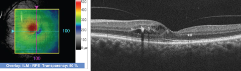 SD-OCT images through the macula of the 72-year-old patient’s left eye. 