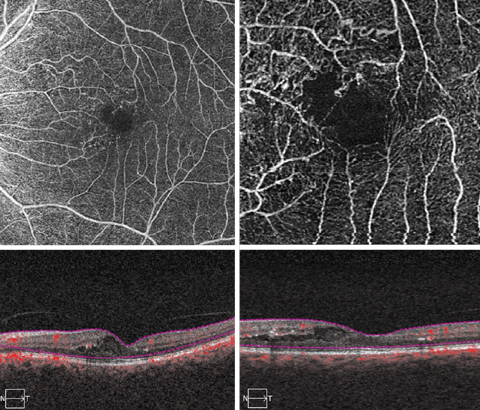 These OCT-A scans show our patient’s macula in great detail.