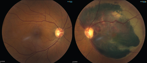 The patient’s left eye (at right) shows subretinal hemorrhaging, but the right eye shows no signs of macular degeneration.