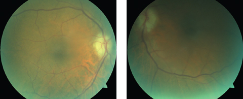 Although our patient’s optic nerve photos were compromised due to her cataracts and imperfect fixation, they show pallid disc edema, which is characteristic of GCA/AION.