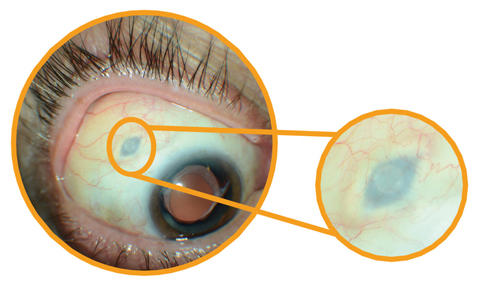 After inserting Roche’s investigational Port Delivery System, the surgeon pulls the conjunctiva back over the implant—leaving the device slightly visible to the naked eye. 
