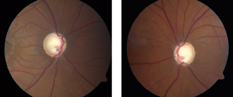 If promising new research is on the right track, patients may be able to avoid this kind of glaucomatous optic nerve damage in the future.