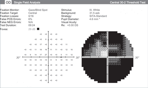 Visual fields like this from an end stage glaucoma patient show the lack of function we’re hoping neuroprotective advancements can halt. 