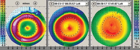 Fig. 2. Measurements taken during a corneal reshaping patient’s first morning show a central island, indicated by the small zone of central corneal steepening. 