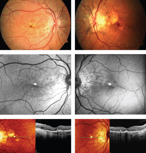 A 52-year-old woman complained of progressive blurriness in both eyes. What can these images and her history combined tell you about her possible diagnosis?