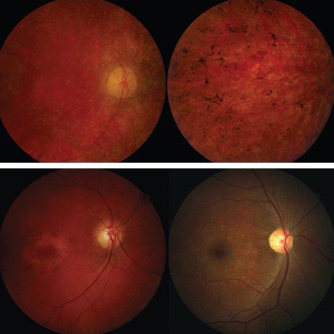 Fig. 5. The top panel shows fundus photos of retinitis pigmentosa. The bottom panel shows fundus images of cone-rod dystrophy (left) and Stargardt disease (right).