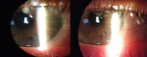 Fig. 2. These images show our patient’s significant improvement in ocular signs and symptoms after two days of treatment.