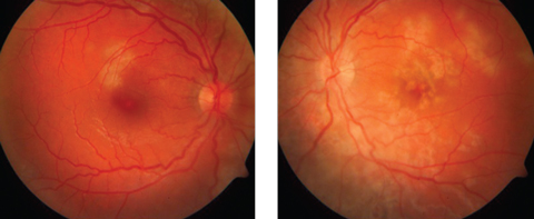 Fig. 1. A-27-year-old female presented one week after a flu-like illness with floaters and blurred vision. Multifocal cream-colored flat placoid lesions were found in the posterior pole of each eye.