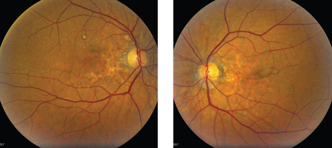 Fig. 1. Although our patient’s initial complaint was a red eye, can you identify any other pathology based on her fundus photographs?