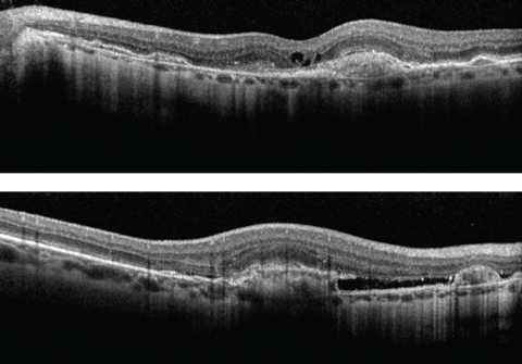 Fig. 2. Can you identify our patient’s diagnosis based on the OCT images of our 58-year-old patient’s right (at top) and left eyes?