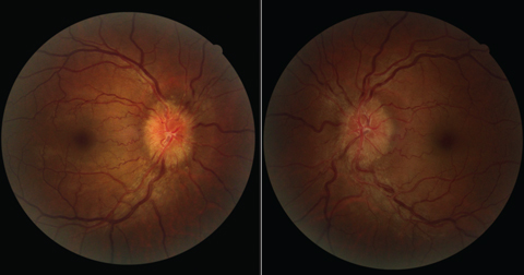 Six weeks after starting isotretinoin for the treatment of acne, this patient with increased intracranial hypertension presented with bilateral optic disc edema.