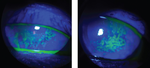 The sodium fluorescein staining used in these patients reveals a compromised corneal surface due to DED.