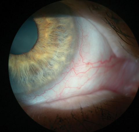 This patient’s injected blood vessels indicate inflammation. In this eye, it can be seen without any vital dyes. 