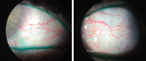 The lissamine green staining here highlights the devitalized cells on the conjunctiva, which indicate ocular surface disease.